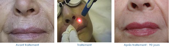 relissage de la peau laser