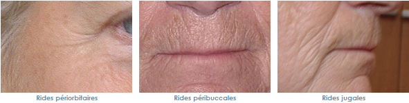 rides traitement laser