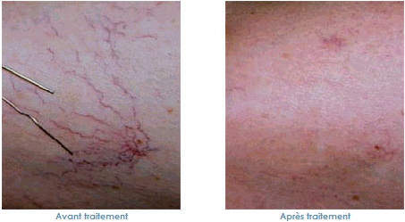 varicosites telangiectasie laser varicosites telangiectasie traitement laser