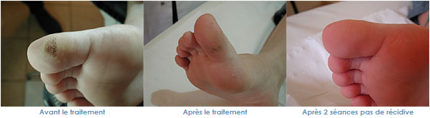 verrues traitement laser